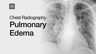 Chest Radiography Pulmonary Edema [upl. by Annoed]