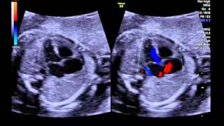 Tetralogy of Fallot Pathogenesis Signs and Management Everything you need to know [upl. by Tacita]