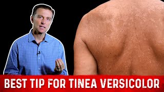 Natural Skin Fungus Tinea Versicolor Home Remedies – Dr Berg [upl. by Atalie]