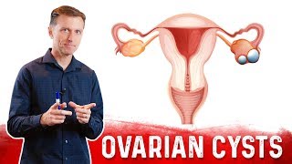 Ovarian Cysts Causes Symptoms amp Natural Treatment – DrBerg [upl. by Asirac]