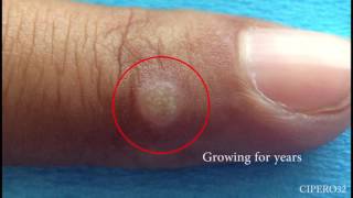 Wart Removal  Cryotherapy [upl. by Attiuqahs206]