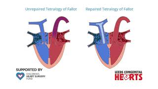 Tetralogy of Fallot [upl. by Ackley392]