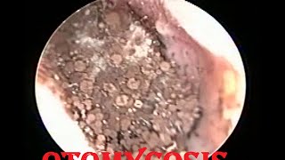 Differentiating fungal infection amp melanoma  Dr Madhu SM [upl. by Leifeste]