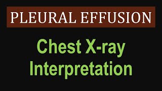 Pleural Effusion  Chest Xray Interpretation [upl. by Kobi]