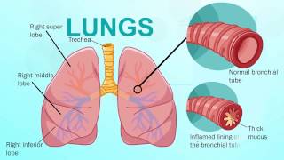 Chronic Bronchitis  Respiratory System [upl. by Zuckerman]