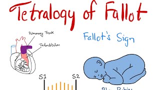 Tetralogy of Fallot TOF  Part 1  Components amp Murmur Explained  Dr Saykat [upl. by Roma]