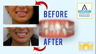 Invisalign Before and After Crowded Teeth [upl. by Thin58]