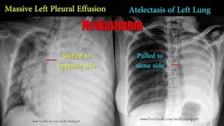 pleural effusion vs atelectasis [upl. by Melville]