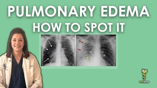 Pulmonary Edema Chest Xray [upl. by Surazal]