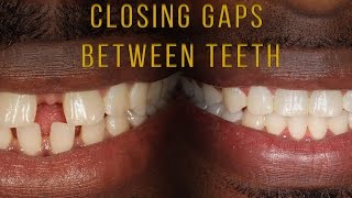 Closing Gaps Between Teeth With Braces [upl. by Akram974]