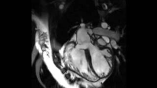 Cardiac MRI  Tetralogy of Fallot [upl. by Assennej]