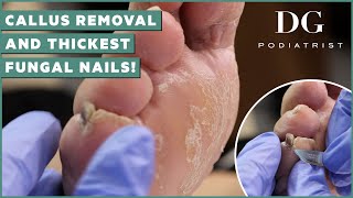 Callus removal from feet and thick toenails cutting treatment  DG Podiatrist The Foot Scraper [upl. by Yelhak]