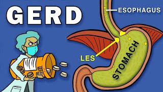 Gastroesophageal Reflux Disease GERD [upl. by Licec]