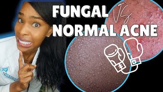 FUNGAL ACNE vs NORMAL ACNE [upl. by Lisle]