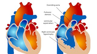 Tetralogy of Fallot TOF [upl. by Asil619]