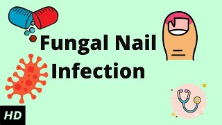 HOW TO TREAT FUNGAL NAIL INFECTION  TINEA UNGUIUM  ONYCHOMYCOSIS [upl. by Nahpets]