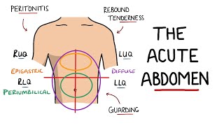 Abdominal Tendinopathy  Causes and Treatment Including Exercises [upl. by Henri]