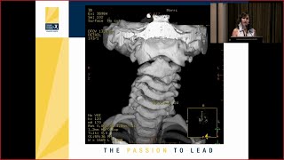 Atlantoaxial C1 C2 Subluxation in the Pediatric Population [upl. by Nerval53]