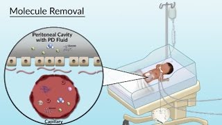 Peritoneal Dialysis by S Su A Olszewski  OPENPediatrics [upl. by Solokin]