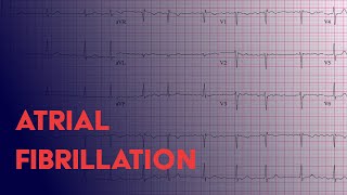 Atrial Fibrillation Afib  EKG ECG Interpretation [upl. by Ulrick]