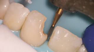 Teeth Bonding  Front tooth filling EXPLAINED [upl. by Udale]