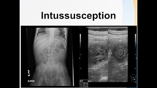 Intussusception [upl. by Hehre]