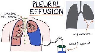 Understanding Pleural Effusions [upl. by Blackmore]