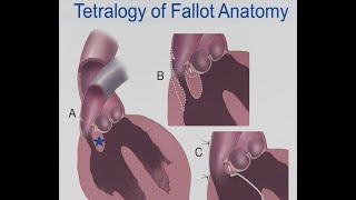 Jasmine S  Heart Surgery Saves MicroPreemie with Tetralogy of Fallot [upl. by Binni]