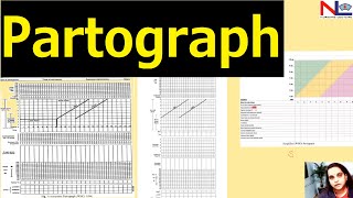 Partograph plotting  Nursing Lecture [upl. by Eelloh]