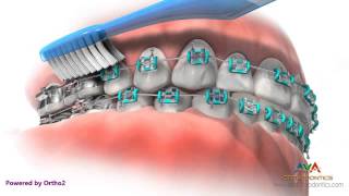 Life with Braces  Brushing amp Flossing [upl. by Cantlon618]