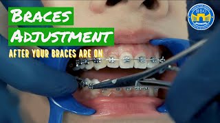 How Do Braces Straighten Teeth [upl. by Goines]