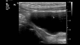 Intussusception US and Reductionmp4 [upl. by Nolitta304]