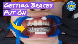 Process of Getting Braces [upl. by Valerle]