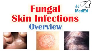 Overview of Fungal Skin Infections  Tinea Infections [upl. by Irrac245]