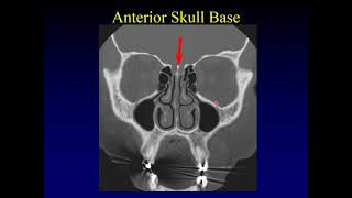 Where does the maxillary sinus open [upl. by Burnham548]