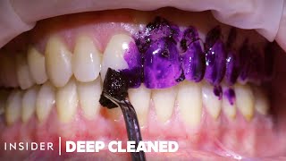 How Teeth Are Professionally Deep Cleaned  Deep Cleaned [upl. by Eiramanna]