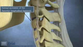 Anterior Subluxation in the Cervical Spine  3D Animation [upl. by Ardeahp]