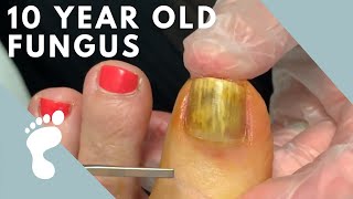 Fungus Takes Over Toenail  Toenail Removal [upl. by Arhsub680]