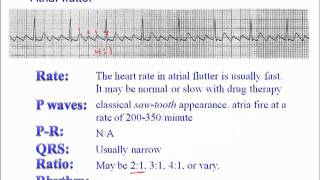 ECG Atrial Flutter [upl. by Hannon118]