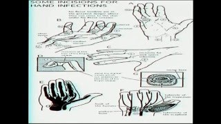 Hand Infections [upl. by Warton]