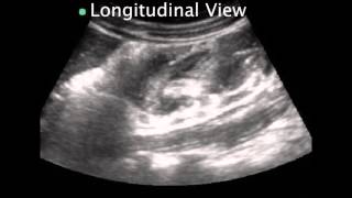 Pediatric Intussusception [upl. by Eirolam958]