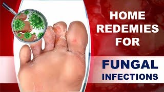 How to Spot and Treat Fungal Nail Infections [upl. by Jarrod802]