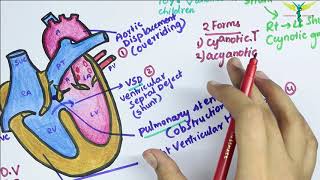 Ventricular Septal Defect VSD  Heart Auscultation  Episode 11 [upl. by Aneej]