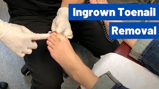 Ingrown Toenail Removal Surgery Video  Permanent Cosmetic Procedure [upl. by Carleton716]