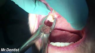 Extraction Of Molar Tooth [upl. by Welker]