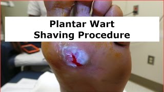 Plantar Wart Shaving Procedure [upl. by Nikolia]