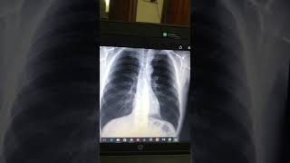 Pleural Effusion Final prof Xray interpretation [upl. by Enrobyalc]