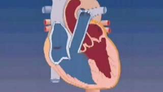 Tetralogy of Fallot [upl. by Fanchette961]